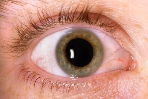 Olho com Glaucoma: pupila maior